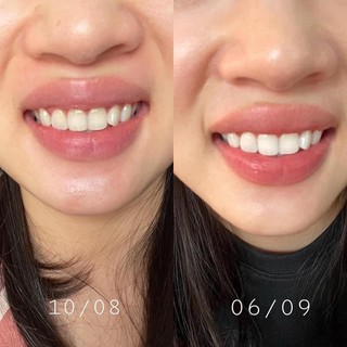 Bột đánh răng cho răng niềng