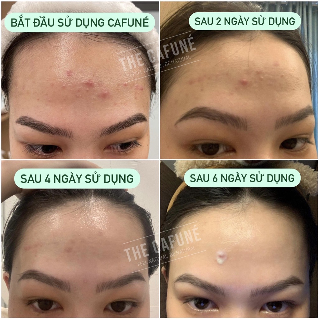 Serum Giảm Mụn Và Thâm Cafuné Essence The Cafuné 20ml