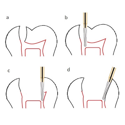 Mũi khoan Endo-Z - Mũi khoan nha khoa mở tủy tránh thủng sàn
