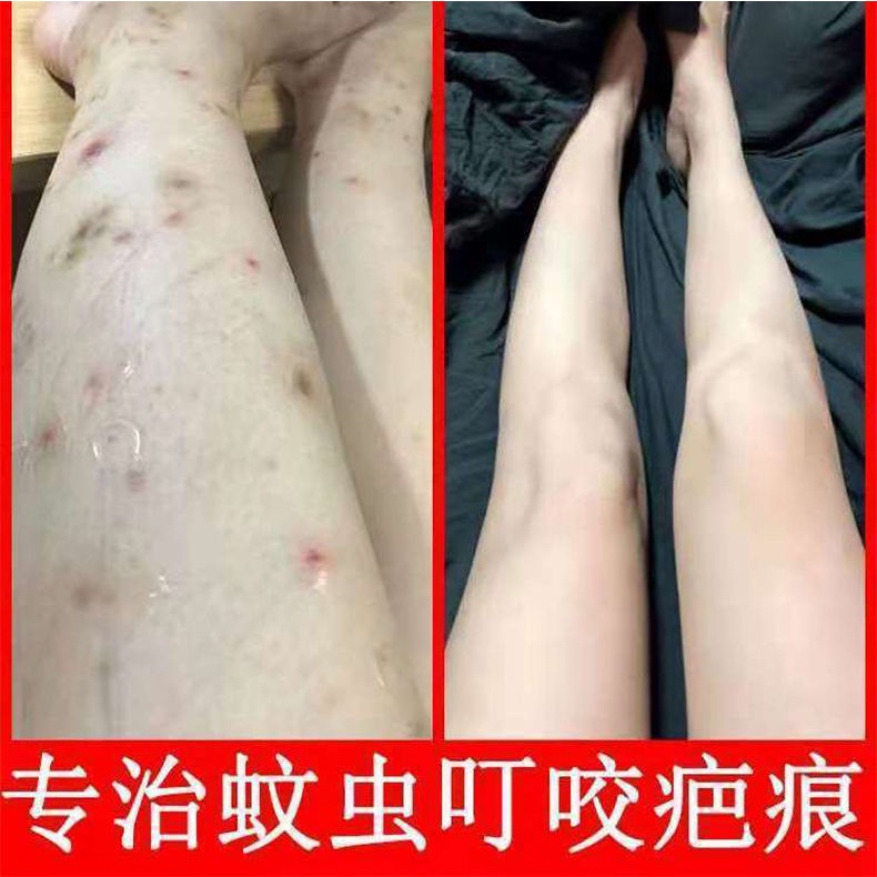 Kem Trị Sẹo Và Vết Rạn Da Chân Thảo Dược 11 / 30rr