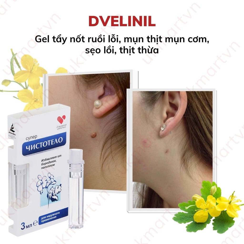 Gel Tẩy Nốt Ruồi DVELINIL Nga Tẩy Nốt Ruồi, Mụn Cơm, Mụn Cóc, Mụn Thịt 3ml