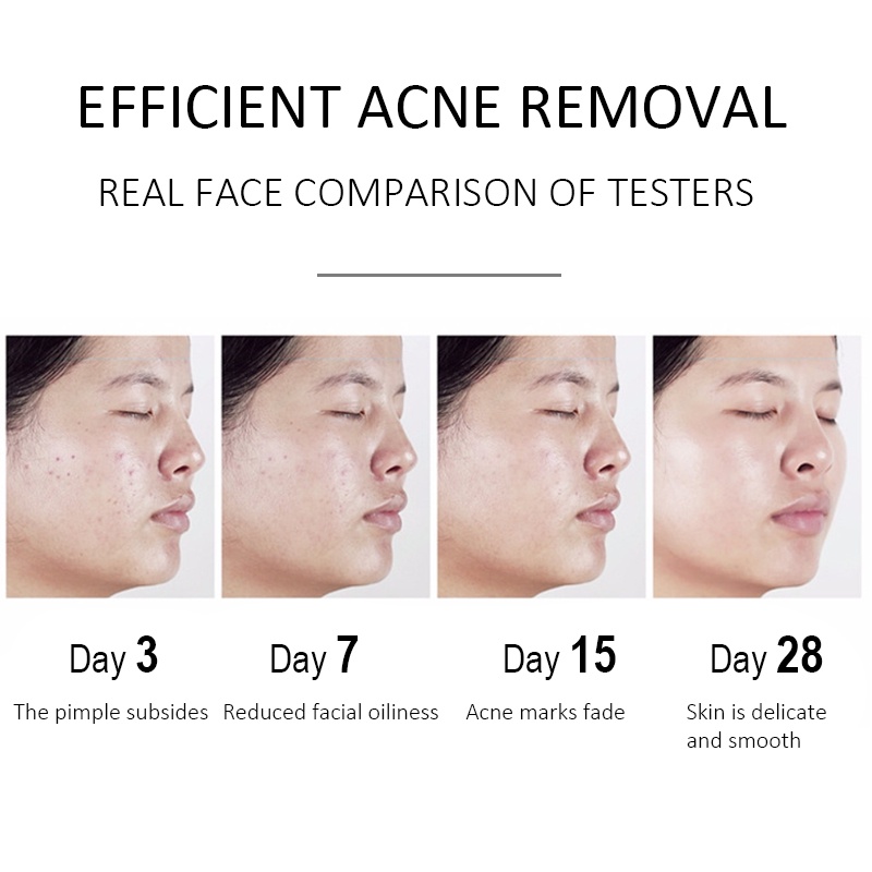 Kem Hỗ trợ giảm mụn Chiết Xuất Thảo Dược An Toàn Và Hiệu Quả 30g