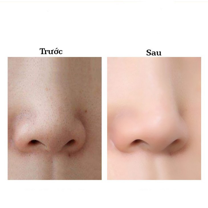 Gel Lột Mụn Cám, Mụn Đầu Đen Peeling Pack Đài Loan