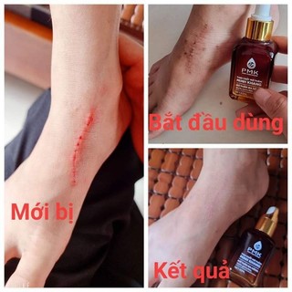 Tinh chất mờ thâm Phúc Minh Khang.