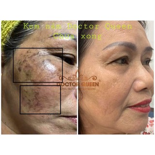 combo nám Doctorqueen ( gồm kem nám,kem trống nắng,serum vàng )
