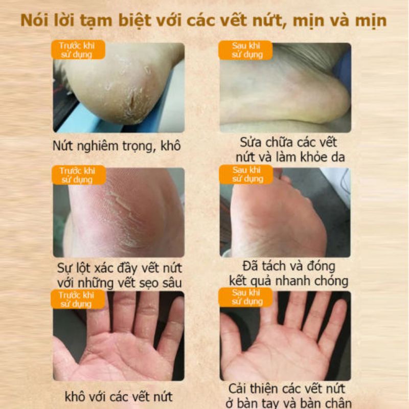 KEM DƯỠNG GÓT CHÂN BẢO LINH