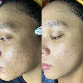 KEM DÀNH CHO DA MỤN MEDIBAC 𝐊𝐄𝐌 𝐌𝐔̣𝐍 𝐓𝐇𝐀̉𝐎 𝐃𝐔̛𝐎̛̣𝐂 𝐌𝐄𝐃𝐈𝐁𝐀𝐂