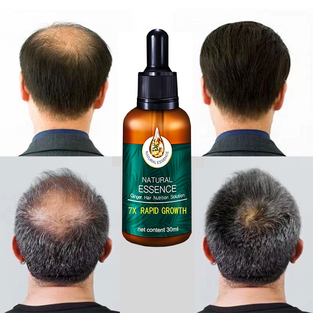 Tinh dầu mọc tóc dầu mọc tóc nhanh mọc tóc chống rụng tóc