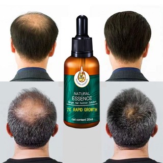Tinh dầu mọc tóc dầu mọc tóc nhanh mọc tóc chống rụng tóc