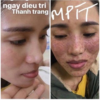 Tái Tạo Thanh Trang( Linh Chi Vi Mụn)