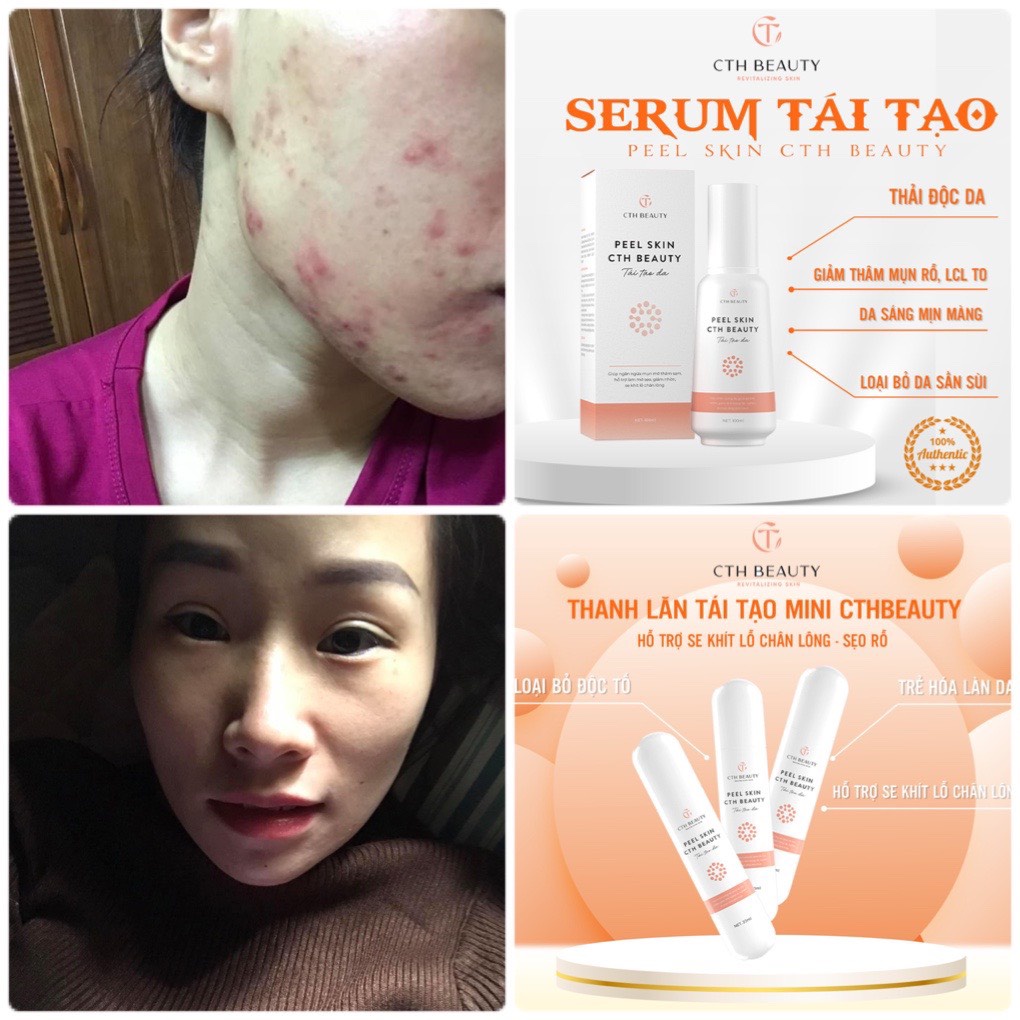 Serum Tái Tạo Peel Skin CthBeautyTinh Chất Detox Da Mụn Sần Lỗ Chân Lông To Dầu Nhờn Nhạy Cảm 100ml