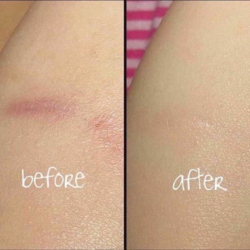 Gel Giảm Thâm, Mờ Sẹo Nhật 10g