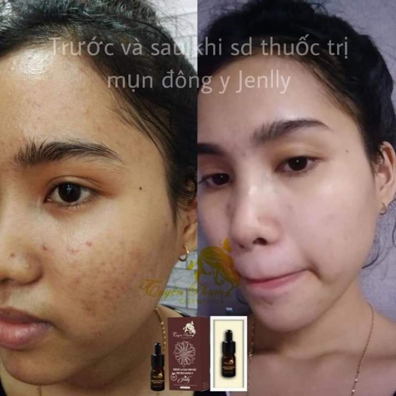 dung dịch bôi mụn