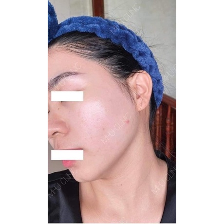 Kem dưỡng GIGI Bioplasma Azelaic Cream 15% 10ml