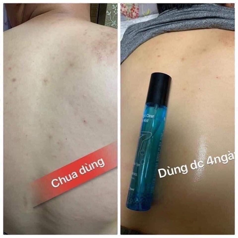 XỊT KHOÁNG VIÊN DA VIÊM LỖ CHÂN LÔNG  LƯNG THE MAGIC CLEAR BODY MIST
