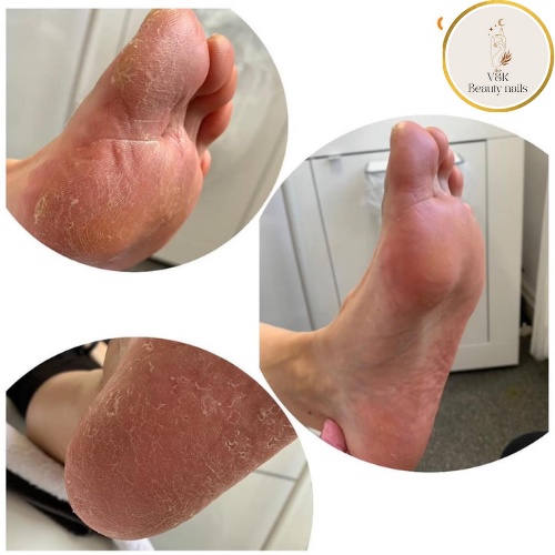 Dung dịch chà gót chân, kem chà gót chân ủ không ngâm Callus eliminator - 118ml chính hãng nhập khẩu