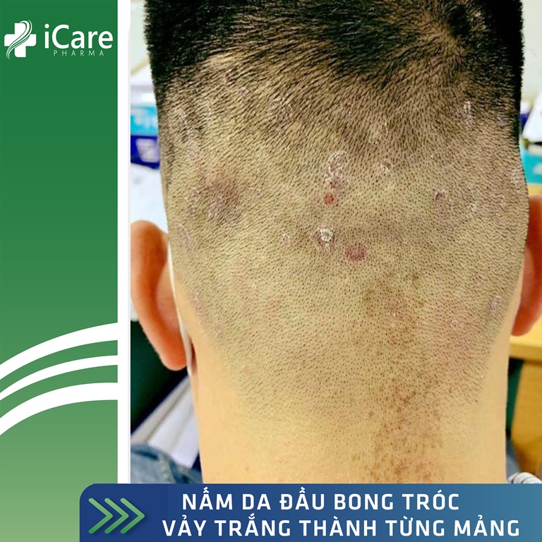 👍👍 Sản Phẩm Ezema 50 - iCare Pharma | Hỗ Trợ Loại Bỏ Nấm Da Đầu Bong Tróc Vảy Trắ