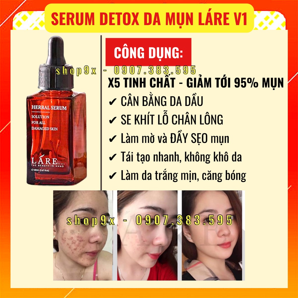 Serum Thanh Dược LÁRE V1 Detox Da Mụn Bản 80ml