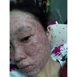 Tái Tạo Thanh Trang( Linh Chi Vi Mụn)