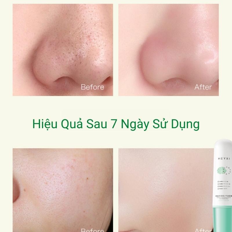 Mặt Nạ Sủi Bọt Heyxi Cao Cấp Mặt Nạ Trắng Da Loại Bỏ Sạch Chất Nhờn Mụn Cám Mụn Đầu Đen Giúp Da Căng Bóng Mịn Màng