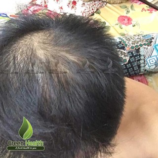 Combo mọc tóc Morr F5 Biotin Ấn