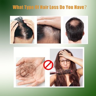 Tinh dầu mọc tóc dầu mọc tóc nhanh mọc tóc chống rụng tóc