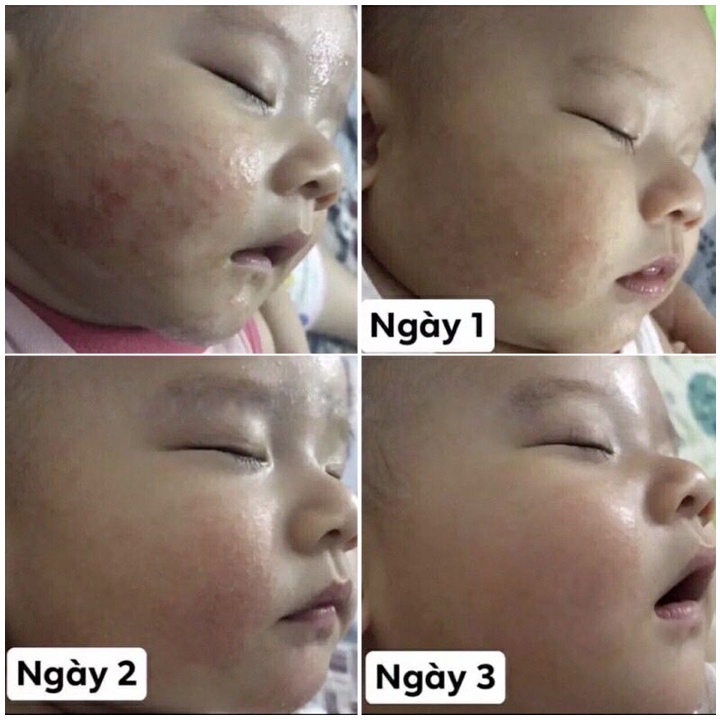 KEM BÔI DA THẢO DƯỢC MINH HÙNG CHÍNH HÃNG