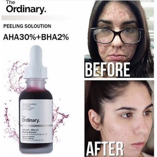 Tinh chất The Ordinary AHA 30% + BHA 2% Peeling Solution ( 30mL )