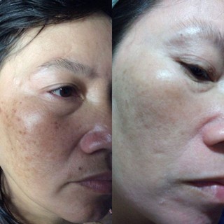 Tái Tạo Thanh Trang( Linh Chi Vi Mụn)