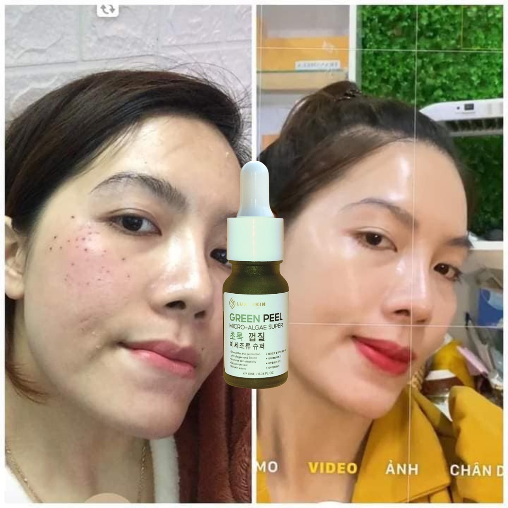 Peel Da Vi Tảo Tái Tạo Da Làm Mờ Vết Thâm Nếp Nhăn, Sẹo Lột Da Để TẩyTế Bào Chết. Thích Hợp Cho Mặt, Nách, Mông Và Lưng
