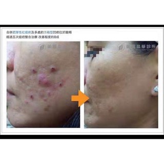 Gel mụn Dermalean 10g