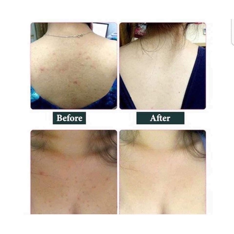 XỊT KHOÁNG VIÊN DA VIÊM LỖ CHÂN LÔNG  LƯNG THE MAGIC CLEAR BODY MIST