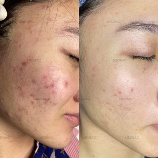 KEM DÀNH CHO DA MỤN MEDIBAC 𝐊𝐄𝐌 𝐌𝐔̣𝐍 𝐓𝐇𝐀̉𝐎 𝐃𝐔̛𝐎̛̣𝐂 𝐌𝐄𝐃𝐈𝐁𝐀𝐂