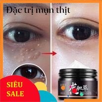 Kem mụn thịt quanh mắt (vinetshop9x)
