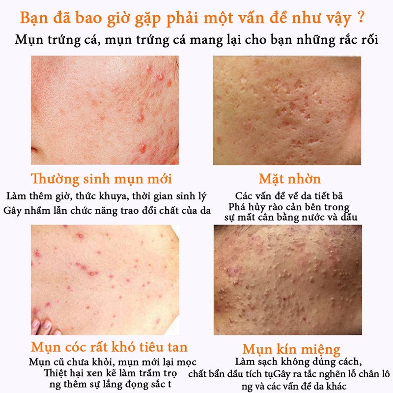 [SIÊU HOT] kem mụn sản phẩm trị mụn Kem dưỡng da MỤN trắng da CỰC TỐT Kem Mụn Giảm Mụn Loại Bỏ Thâm Mụn Làm Mờ Sẹo Tẩy Tế Bào Chết Sáng Da Kiểm Soát Bã Nhờn