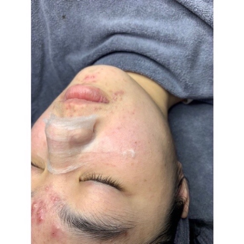 Serum moc tuyet giam mun giam tham