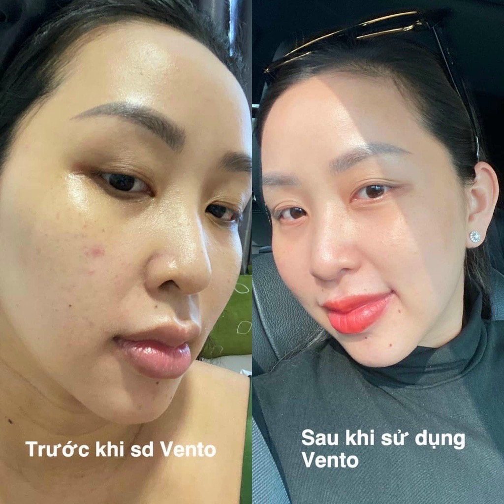 Bộ Dưỡng Da Cao Cấp Skincare Vento Vivere Giúp Da Trắng Sáng, Khoẻ Mạnh Hơn