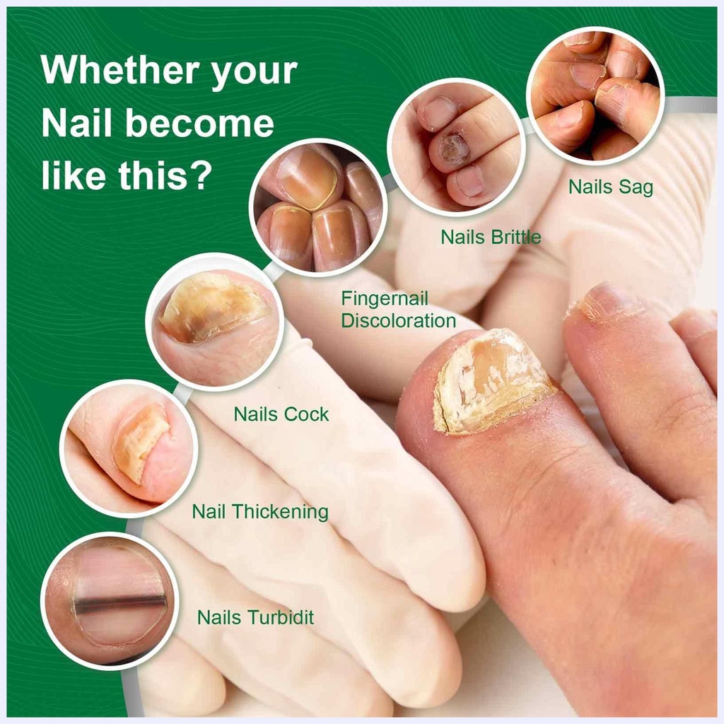 Tinh chất phục hồi chăm sóc móng hư tổn