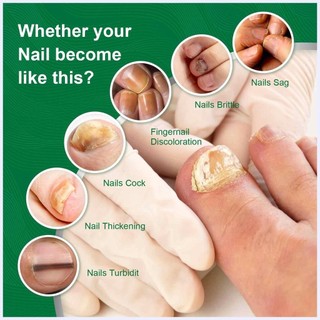 Tinh chất phục hồi chăm sóc móng hư tổn