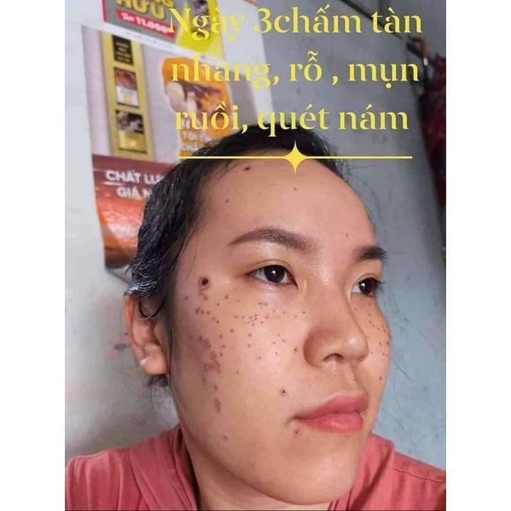 Chấm Tàn Nhang, Nám, Làm Đầy Sẹo Rỗ Mụn, Rùi An Toàn Tichi Beauté - Hamdmade