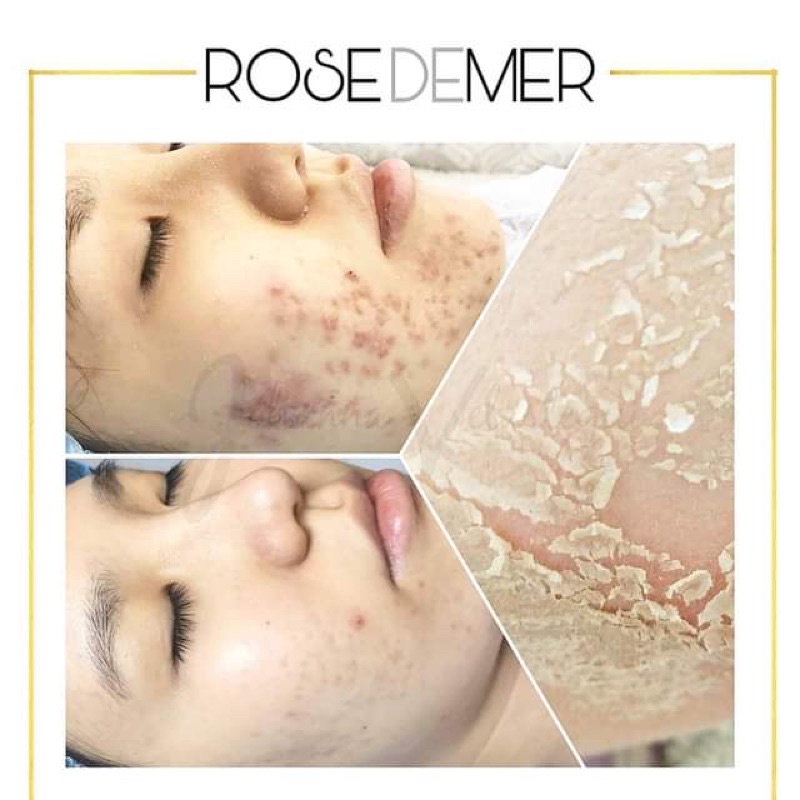 Combo Peel Thảo Dược Ch.ris.tina Rose.demer 2A +2B Sea Her.bal