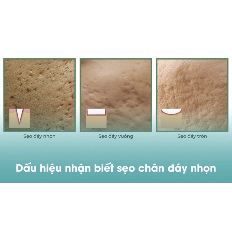 TCA 80% chấm sẹo rỗ , sẹo đấy nhọn hiệu quả