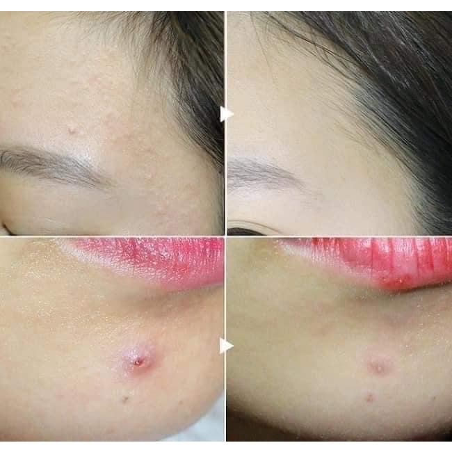 Gel Hỗ Trợ Giảm Sưng Mụn Benzac AC 5% - 15g