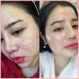 Serum mụn TA
