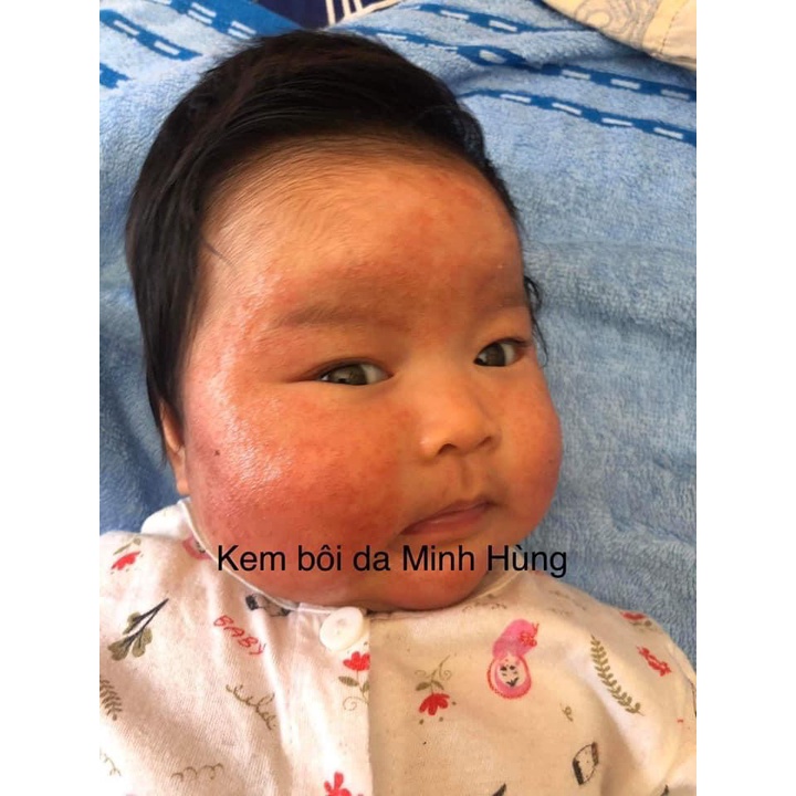 KEM BÔI DA THẢO DƯỢC MINH HÙNG CHÍNH HÃNG