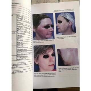 [Tài Liệu Tham Khảo ] Peel Hoá Chất