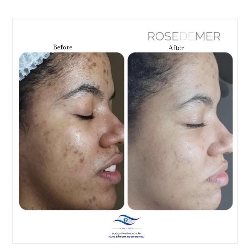 Combo Peel Thảo Dược Ch.ris.tina Rose.demer 2A +2B Sea Her.bal