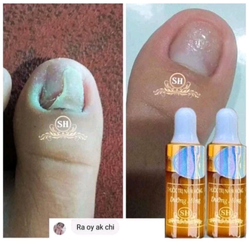 Serum đánh bay nấm móng, hư khoé , bọng móng gia truyền