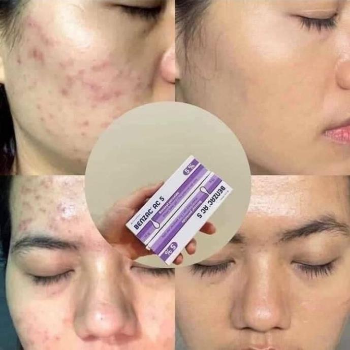 Kem chấm mụn Benzac AC 5 Galderma  - 15g