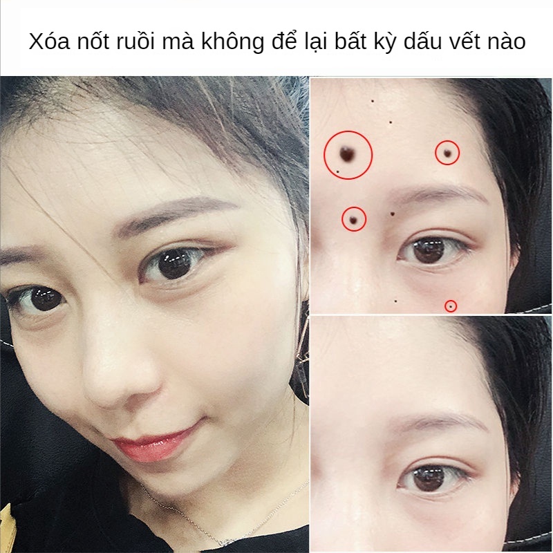 Kem Hỗ Trợ Giảm Mụn Cóc Tẩy Mụn Thịt Dư Trên Da